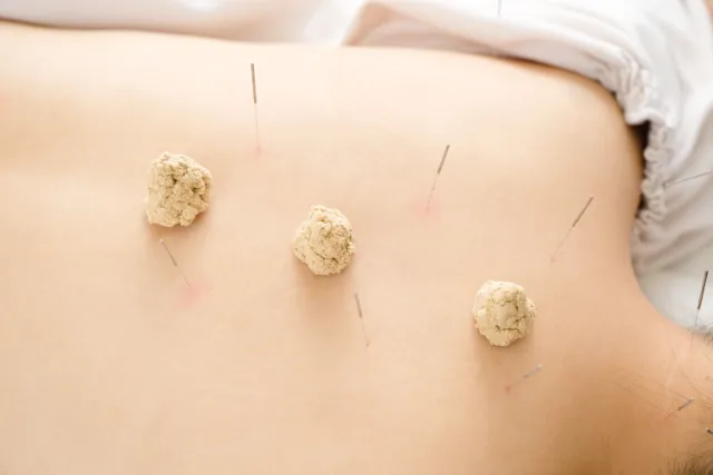 acupuncture and moxibustion on the back of a woman 2023 05 23 22 51 47 utc