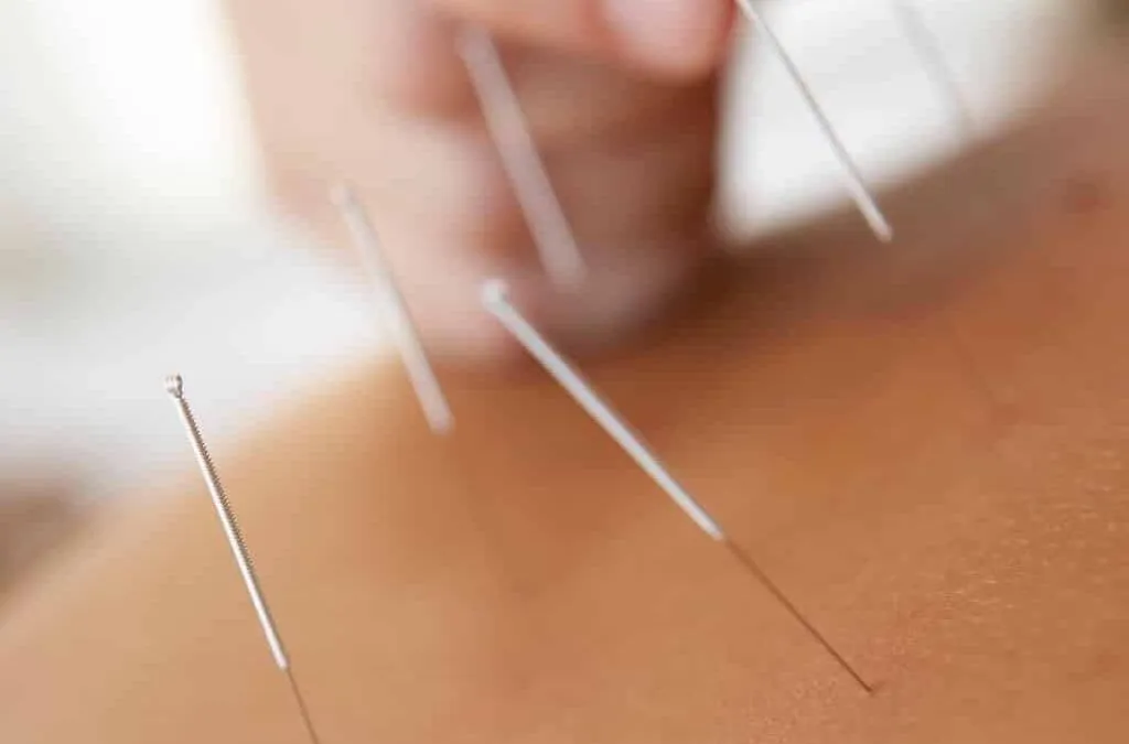 acupuncture sheffield physio clinic 1024x675 1